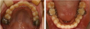 歯の裏側（舌側）矯正装置（リンガルアーチタイプ）