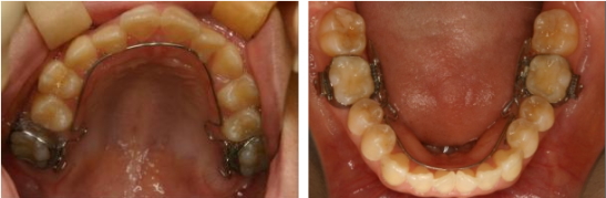 歯の裏側（舌側）矯正装置
