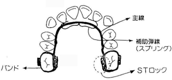 歯の裏側(舌側)矯正装置(リンガルアーチタイプ)