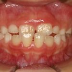 前歯の永久歯が斜めに生えてきたが大丈夫でしょうか？