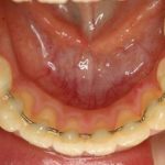 矯正した後、きれいに並んだ歯はずっと維持できますか？