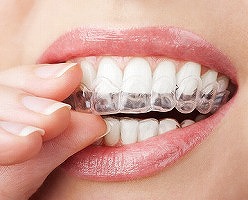 半永久的に歯並びは変わらない？
